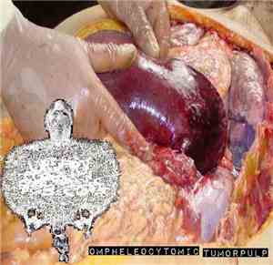 Urinary Tract Infection From Severe Pus Clots - Ompheleocytomic Tumorpulp
