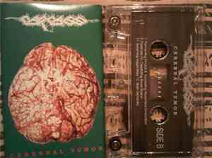 Carcass - Cerebral Tumor