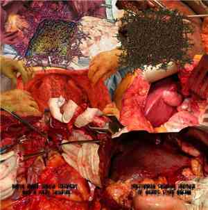 Disemboweled Bodies In Abandoned Trenches, Submersed In Infected Medical Wastes - Barium Enema Through Colostomy With A Foley Catheter / Percutaneous Catheter Drainage Of Amoebic Liver Abscess