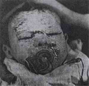 T.E.F. - Seudoeczema Piogeno